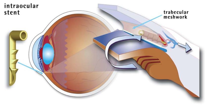 Intraocular Stents for Glaucoma in Birmingham